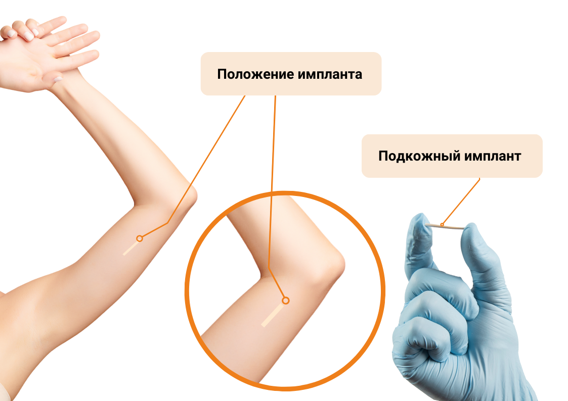 Установка подкожного гормонального контрацептива (Импланон)